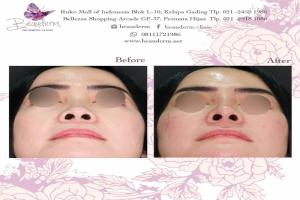 Filler Hidung / Nose Filler